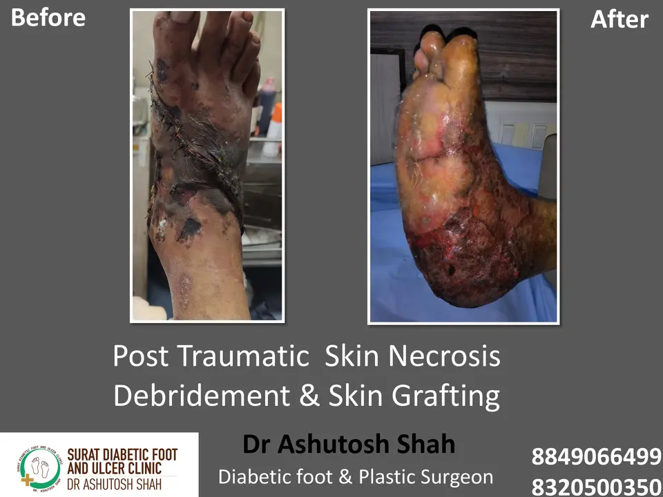 Diabetic Foot  PPT sunita.pptx-1.webp